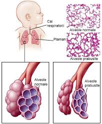 We did not find results for: Probleme De Sanatate Ale Bebelusului Prematur Desprecopii Com