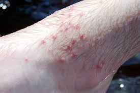 Image result for scabies human bites