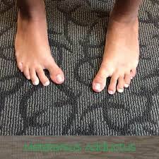 Image result for In-Toeing