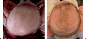 هل سأندم إذا لم أعالج الرأس المسطح؟