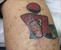 Saturday and evening by appointment only. Tattoo Associated Complications And Related Topics A Comprehensive Review Petrochko Jm Krakowski Ac Donnelly C Wilson Jb Irick Jb Stawicki Sp Int J Acad Med
