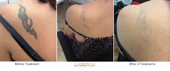 You may not post photos of tattoos unless they are yours. Laser Tattoo Removal Using Picosure Laseryou Picosure Tattoo Removal Skin Rejuvenation Soprano Titanium Ice Hair Removal