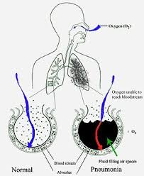 Pneumonia of the right middle lobe with silhouette sign. Pneumonia Wikipedia