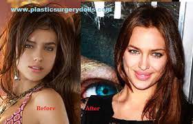 Ирина шейк), is a russian model and actress who received international recognition when she appeared as the first russian model on the cover of the 2011 sports illustrated swimsuit issue. Can T Shayk This Mistake Plastic Surgery Lip Surgery Irina Shayk