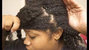 Boil one full cup of water, add a pinch of cassia herbs or green tea herbs. Getting Rid Of Dandruff Using Listerine Youtube
