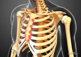 Backpod Helps Costochondritis And Tietze S Syndrome Bodystance