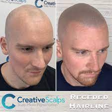 Reddit gives you the best of the internet in one place. Scalp Micropigmentation Before After Results Best Smp Results