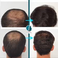 The cost of hair transplant in turkey varies depending on the clinic and the hair transplant method. Grade 3 Grade 3 Vertex Grade 4 Hair Loss Maral Hair