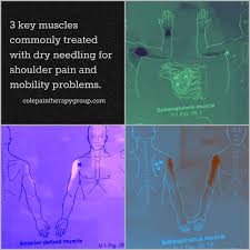Shoulder programme systems affecting daily functioning and ability to work. An Explanation Of Dry Needling For Shoulder Pain
