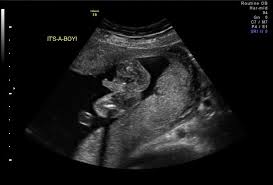 Your boy stock images are ready. How To Read Ultrasound In Urdu Learn Ultrasound Report Parhne Ka Tarika Hindi Me Baby Boy Or Girl Urdu Hindi