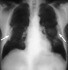 Pleural plaques tend to cause only mild breathing . Chest Radiograph Of A Patient With Previous Asbestos Exposure Who Has Download Scientific Diagram