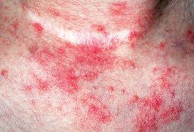 Small red spots across your back, chest or abdomen. Pictures Of Blotchy Skin Rosacea Hives Psoriasis And More