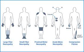 Image result for Peripheral Neuropathy