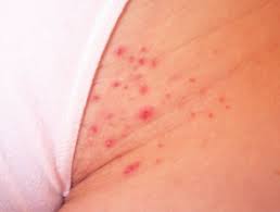An ingrown hair after waxing happens when the hair never breaks the skin's surface as it grows or does come out of skin first and then grows back into the skin. Waxing Dermnet Nz