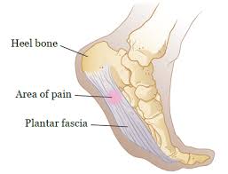 Bone cancer destroys normal bone tissue. Plantar Fasciitis Memorial Sloan Kettering Cancer Center