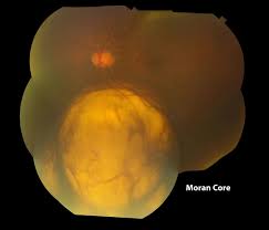 Image result for Coloboma