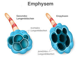 Die verengung entsteht durch eine entzündung der kleinen atemwege (obstruktive bronchiolitis). Copd Was Ist Copd Copd Symptome Definition Pflege De