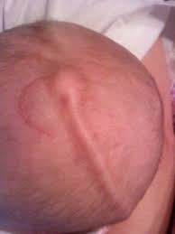 Shunt Placed Under The Skin Health Brain Surgery Awareness