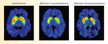 How much alcohol does it take to get addicted? Treatment And Recovery National Institute On Drug Abuse Nida