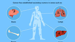 This type can develop in women of any age. Stage 4 Breast Cancer Diagnosis Treatment Survival