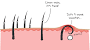Groin Shaving Ingrown Hair