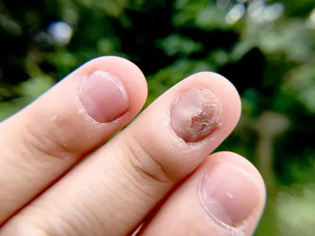 Jamur Kuku (Tinea Unguium): Gejala, Penyebab, Obat, dll.