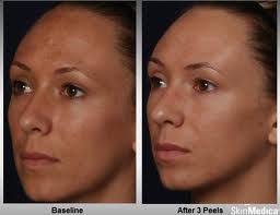 Home Yuva Medical Spa Chemical Peel Chemical Skin Peel Natural Aging Skin Care