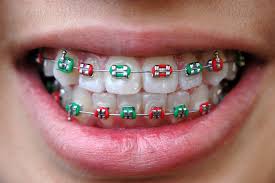 One of our bestsellers in port dickson! Dental Braces Specialists Malaysian National Specialist Register
