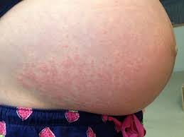 Let the suds sit on your skin for at least five minutes, 10 is better. Pruritic Urticarial Papules And Plaques Of Pregnancy Puppp Rash