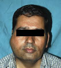 Tuberculosis of Temporomandibular Joint Presenting as Swelling in the  Preauricular Region