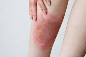 Image result for allergy rash on the legs
