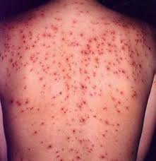 Boala lyme, în principal, este produsă de căpuşa de căprioară, aceasta fiind vectorul primar. Explozie De HepatitÄƒ A RujeolÄƒ RubeolÄƒ Si Boala Lyme
