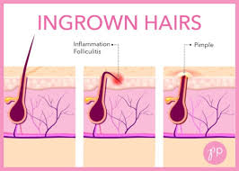 Also it will make your skin silky smooth. How To Remove Scars From Ingrown Hairs Quora