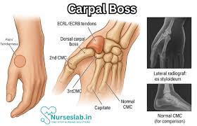 Image result for Capitate Bone