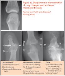 Gout Oa Ra Rheumatoid Arthritis Symptoms Rheumatoid Arthritis Rheumatoid Arthritis Vs Osteoarthritis