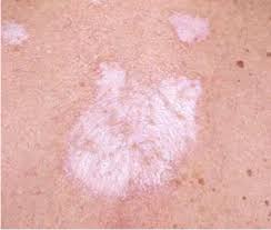 Image result for itchy skin rectum