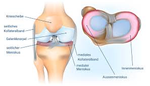In dieser zeit heilt die quetschung in der regel folgenlos aus. Meniskus Meniskusriss Und Meniskuserhaltende Operation