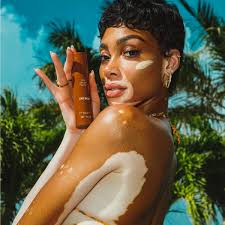 Image result for vitiligo model