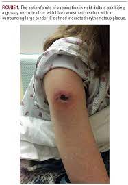 From late latin eschara scab, from greek eskhara hearth, pan of hot coals (which could inflict burns); Article Jddonline Journal Of Drugs In Dermatology