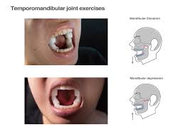 Image result for Trismus