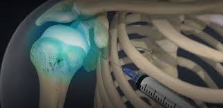 Image result for Shoulder Injection