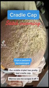 Image result for Cradle Cap
