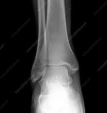 Image result for Ankle XRay