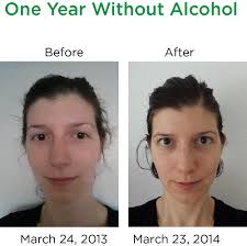 Before After One Year Without Alcohol Sunny Sanguinity Effects Of Alcohol Alcohol Alcohol Pictures