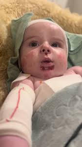 Her favorite way to chat? Blowing raspberries! 💖 Our little fighter  spreading the joy #EBStrong #EBWarrior #BUTTERFLYBABY #skindisease  #epidermolysisbullosa #EBLife #babymoments