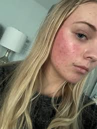 Can touching shingles sores trigger chicken pox in someone with LCH?