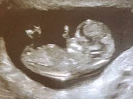 Kann Man In Der 13 Ssw Das Geschlecht Erkennen Schwanger Wer Noch