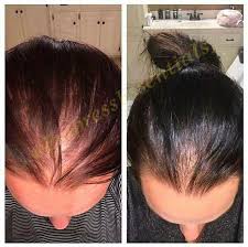 Ginger germinal oil, ginger hair growth serum, ginger essential oil stop hair loss hair, thinning treatment hair growth oil for women & men 30ml (1 pack) 3.7 out of 5 stars 87. Hair Loss Treatment Hair Growth Cream 1 Month Supply Balding Etsy Hair Regrowth Cream Hair Regrowth Women Hair Growth Treatment