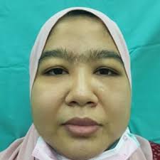 Mini-implant (Cibei, Ningbo, China, 2 mm in diameter and 13 mm in length)