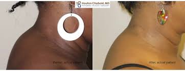 The lump at the back of the neck can be alarming but it is usually painless and harmless and which have no impact in the daily activities of an swollen lymph node is among the most common cause of lump on back of neck. How To Get Rid Of A Buffalo Hump Excess Fat Behind The Neck
